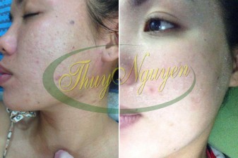 Liệu Trình Điều Trị Mụn - Sẹo Rỗ - Mụn Thâm - Khách Hàng TN 311016